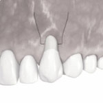 Zahnheilkunde Gaa Köln Braunsfeld | Parodontologie Verschiebelappen 1