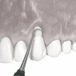 Zahnheilkunde Gaa Köln Braunsfeld | Parodontologie Verschiebelappen 2
