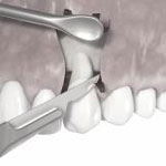 Zahnheilkunde Gaa Köln Braunsfeld | Parodontologie Verschiebelappen 4