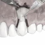 Zahnheilkunde Gaa Köln Braunsfeld | Parodontologie Verschiebelappen 5