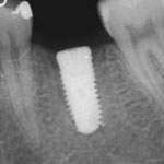 Zahnheilkunde Gaa Köln Braunsfeld | Implantat Unterkiefer