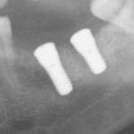 Zahnheilkunde Gaa Köln Braunsfeld | Implantat Unterkiefer