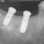 Zahnheilkunde Gaa Köln Braunsfeld | Implantat