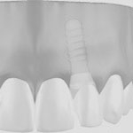 Zahnheilkunde Gaa Köln Braunsfeld | Implantologie 1