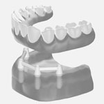 Zahnheilkunde Gaa Köln Braunsfeld | Implantologie 6