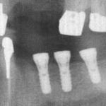 Zahnheilkunde Gaa Köln Braunsfeld | Implantologie C