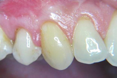 parodontologie verschiebelappen vorher zahnheilkunde gaa köln braunsfeld